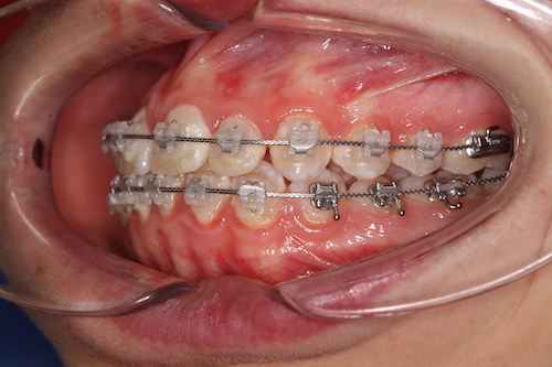 Рис 1.  Желтые зубы из за скопившегося налета и неадекватной гигиены.