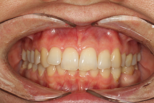 Рис 1. Результат через 9 лет после ортодонтического лечения. Неудовлетворительный результат с точки зрения эстетики.