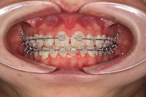 Рис 1.  Желтые зубы из за скопившегося налета и неадекватной гигиены.