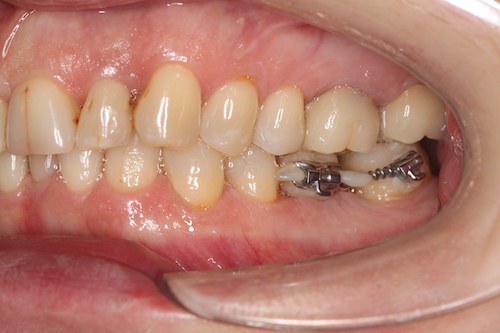 Рис. 2 коронка на импланте зуб 4.6- используется как независимая опора для подъема зуба 4.7. сам имплант остается неподвижным ни при каких усилиях.