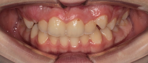 рис 2. Ситуация до начала лечения. Кроме неровных зубов отмечается плохая гигиена полости рта.
