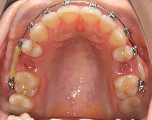 рис 3. На этапе ортодонтического лечения произведена имплантация в области вторых премоляров, после раскрытия необходимого пространства для имплантации за счет брекет-системы.