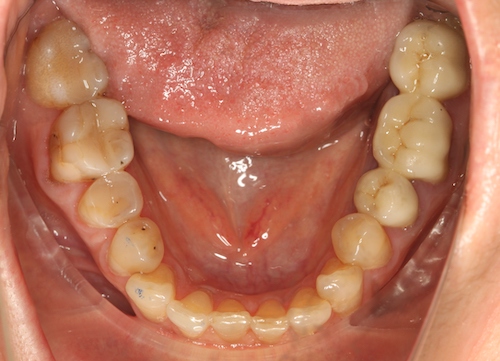 рис 3. «Cкученность» передних зубов в более позднем возрасте
