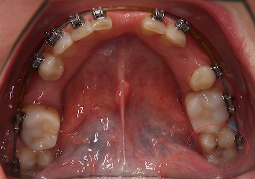 рис 3. Брекет не мешает лечению кариеса на последнем зубе.