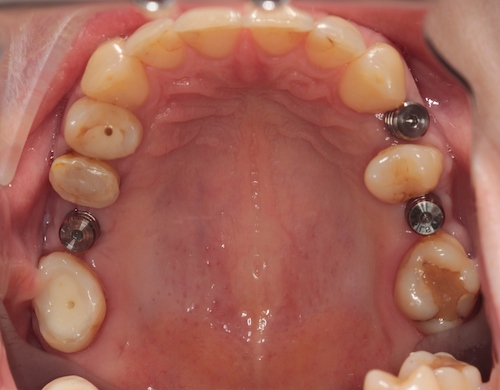 рис 4. Уже имеющиеся имплантаты до начала ортодонтического лечения усложняют работу врача-ортодонта, но не делают ее невозможной.