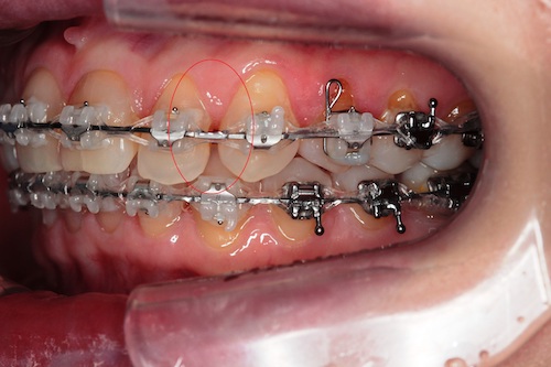 Рис 4 для лечения кариеса между зубами неободимо снятие как минимум ортодонтической дуги.