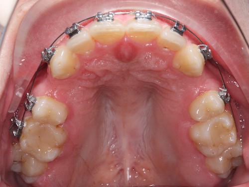 Рис 5. Ситуация с удалением зубов на верхней челюсти.