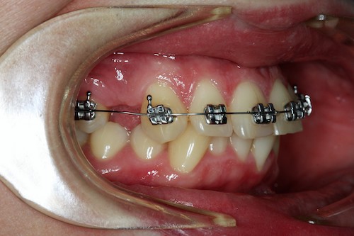 Рис 5. Ситуация с удалением зубов на верхней челюсти.