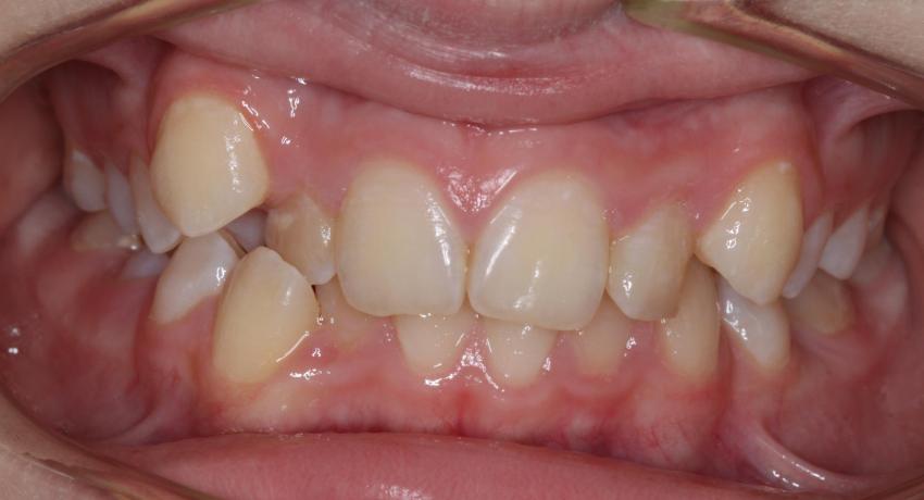 Неровное положение зубов верхней и нижней челюсти осложняют очистку зубов щеткой и прохождение зубной нити.