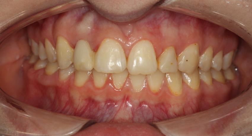 При ровном положение зубов, но наличии огрехов в гигиене так же может возникнуть кариес.