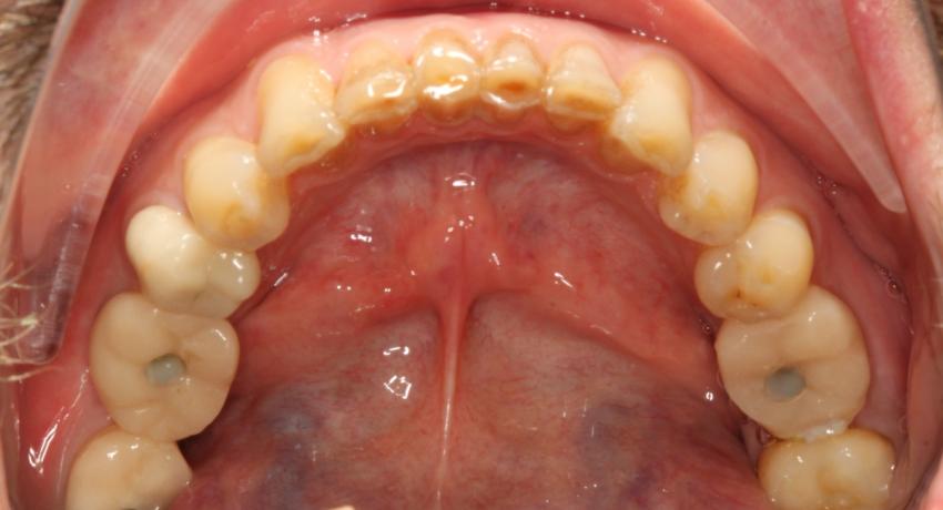 Повышенная стираемость передней группы зубов  как результат перегрузки жевательной системы