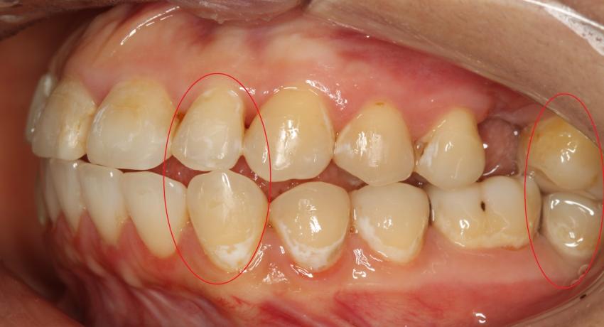Лишние( неблагоприятные ) контакты между зубами верхней и нижней челюсти.
