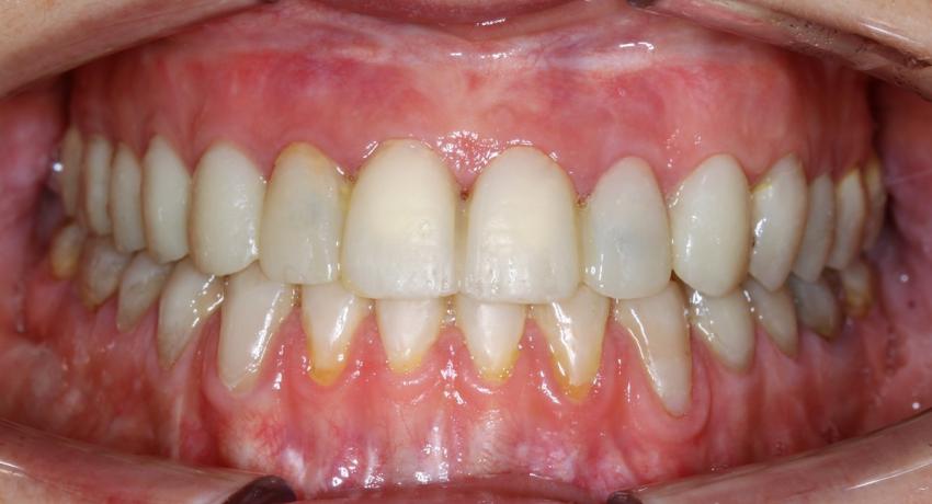 Этап временного протезирования. Восстановление анатомически правильной формы зубов с помощью временного материала у пациентки с чрезмерной стриемостью зубов.